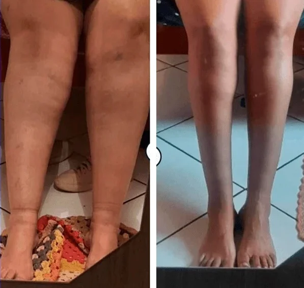 lipedema-antes-e-depois12