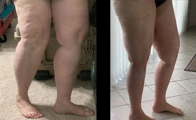 lipedema-antes-e-depois17-768x469