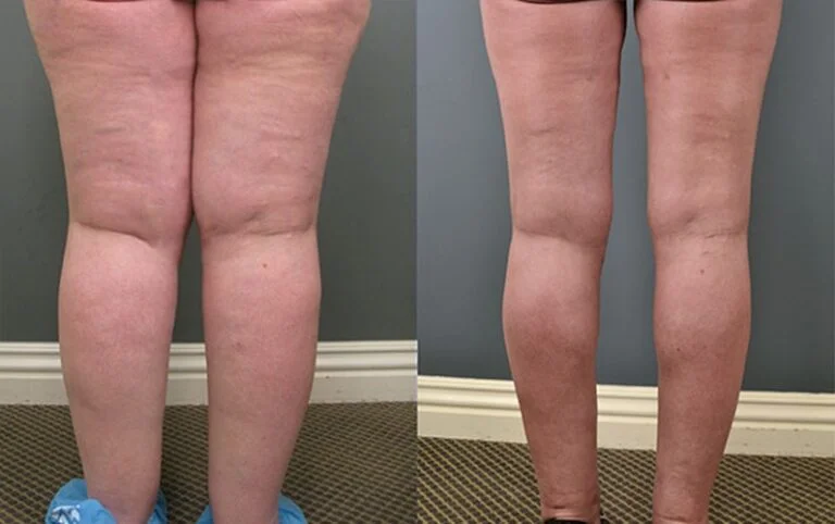 lipedema-antes-e-depois19-768x482
