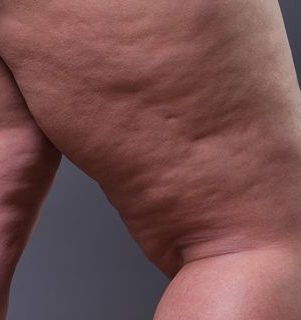 Lipedema-dores