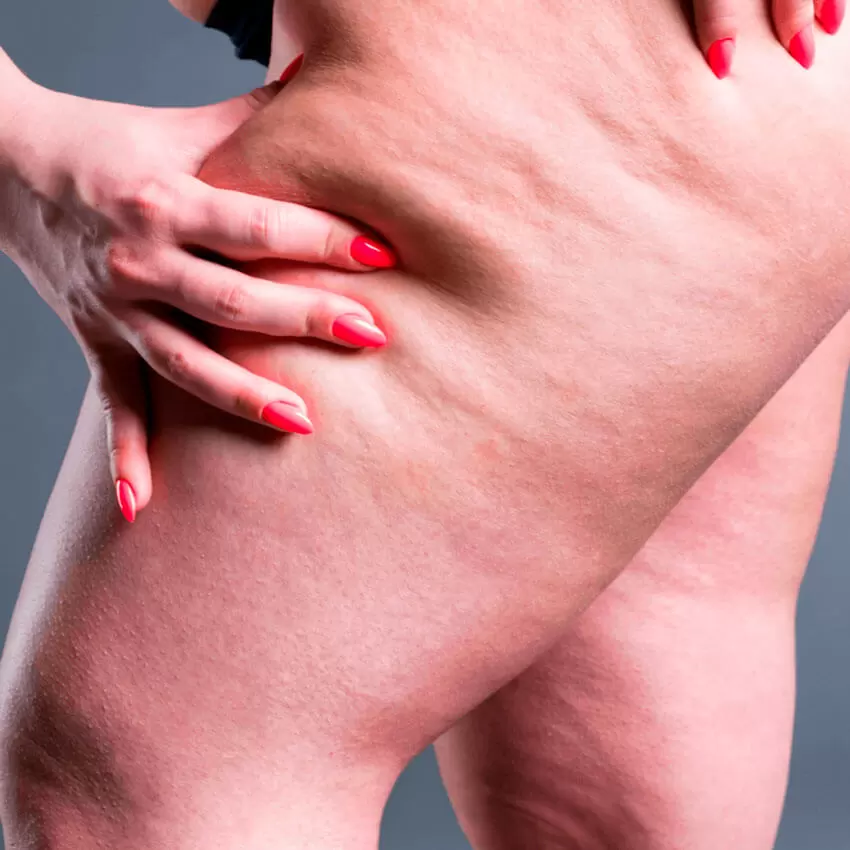 Lipedema-foto